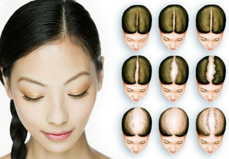 female-pattern-hair-loss